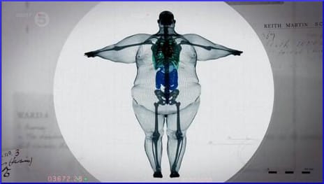 x-ray of a 900-pound man