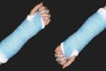 hand-in-a-cast
